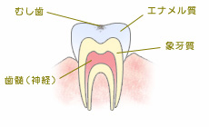 C0【ごく初期の虫歯】