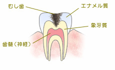 C2【象牙質の虫歯】
