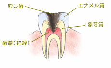 C3【歯髄まで達した虫歯】