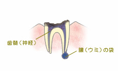 C4【歯根まで達した虫歯】